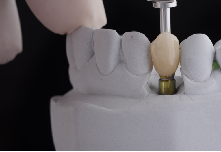 dental implants