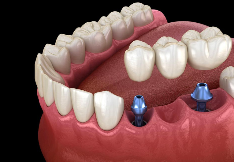 dental implants