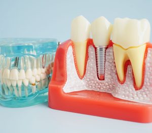 dental implants
