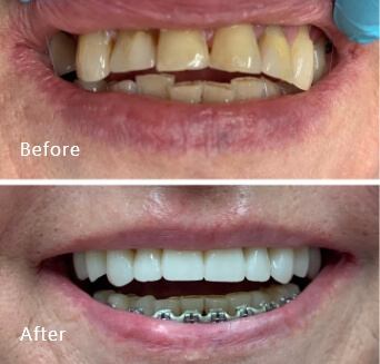 before and after treatment at Royal Dental Care