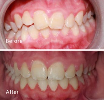 before and after treatment at Royal Dental Care