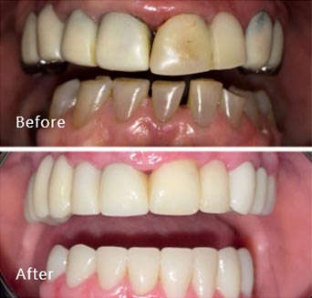 before and after treatment at Royal Dental Care