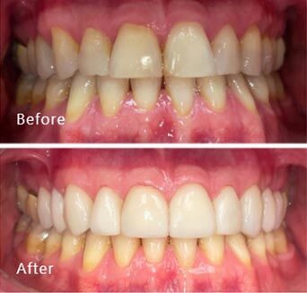 before and after treatment at Royal Dental Care