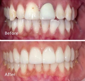 before and after treatment at Royal Dental Care