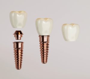Dental implant components including a titanium post, abutment, and ceramic crown, illustrating advanced dental technology for precise and effective implant procedures.