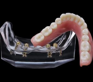 dental implants